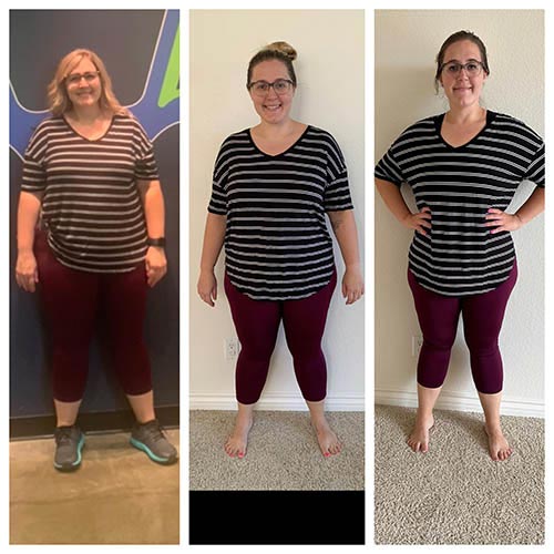 tijuana-bariatrics-gastric-sleeve-before-after_Ashlie-Anderson