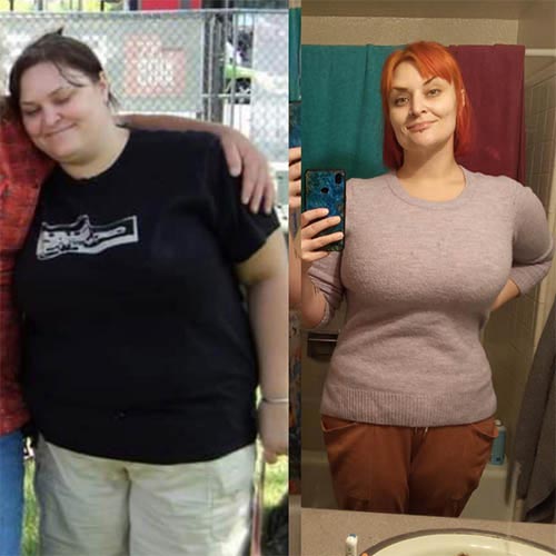 tijuana-bariatrics-gastric-sleeve-before-after_Athena-Maxwell-Clark