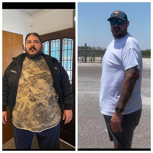 tijuana-bariatrics-gastric-sleeve-before-after_Daniel-Schlesinger