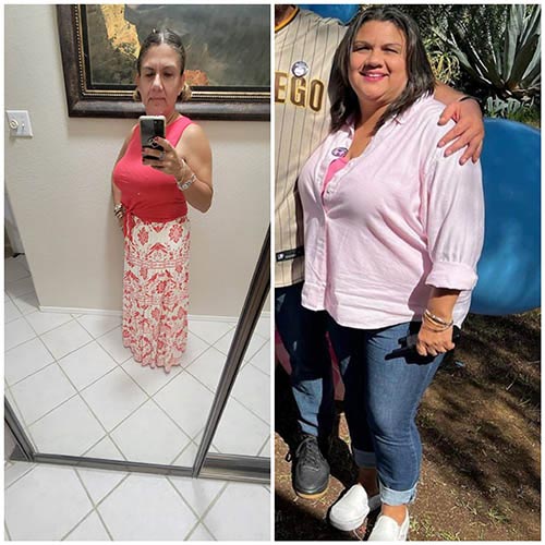 tijuana-bariatrics-gastric-sleeve-before-after_Edna-Tamayo