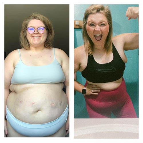 tijuana-bariatrics-gastric-sleeve-before-after_Emilhy-Hasse
