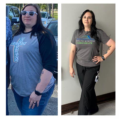 tijuana-bariatrics-gastric-sleeve-before-after_Jessica-McDonald-Jones