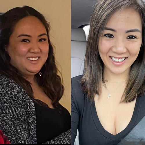 tijuana-bariatrics-gastric-sleeve-before-after_Marjorie-Guevara-Tilton