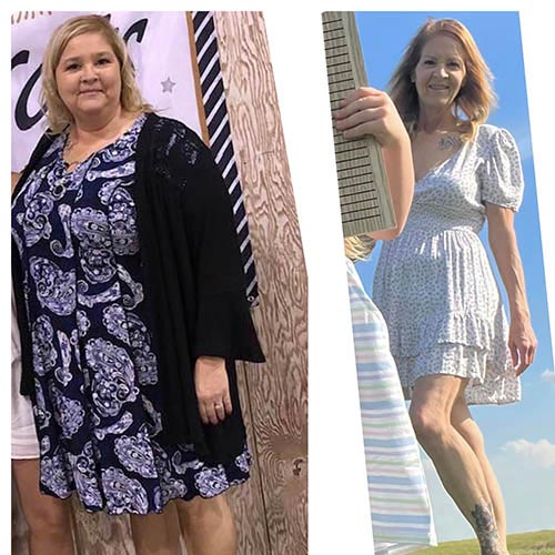 tijuana-bariatrics-gastric-sleeve-before-after_Michelle-Lee-Emerich