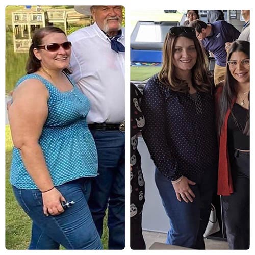 tijuana-bariatrics-gastric-sleeve-before-after_Sara-Marie-Brown-2