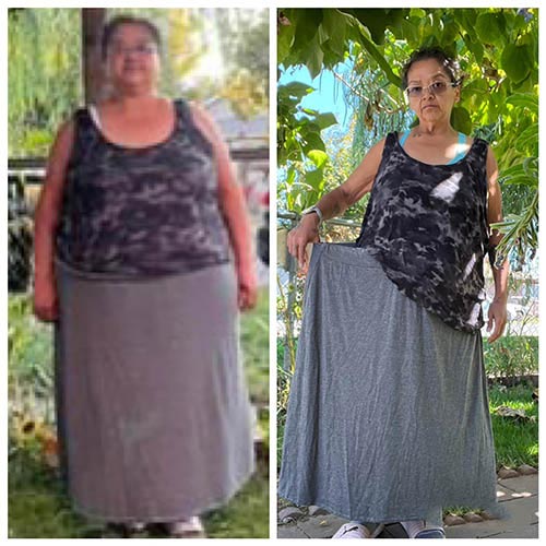 tijuana-bariatrics-gastric-sleeve-before-after_Teresa-Chavez
