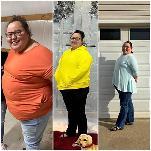 tijuana-bariatrics-gastric-sleeve-before-after_anna-cannon