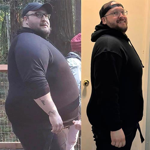 tijuana-bariatrics-gastric-sleeve-before-after_piers-bachman-2